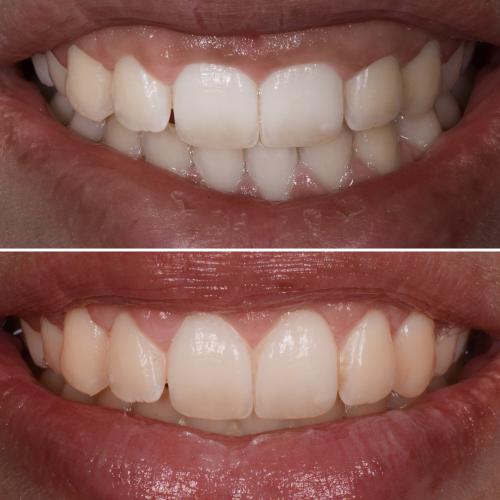 Cirurgia Plastica Gengival - Dr. Pedro Sá
