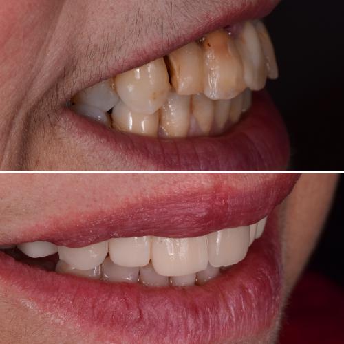 Implantes Dentários - Dr. Pedro Sá